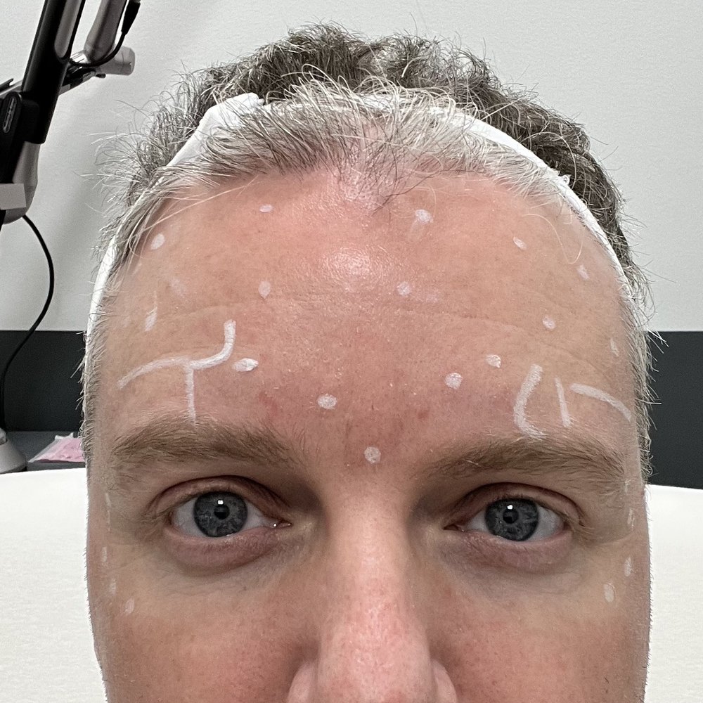 LaserAway - Map out of injections after a serious of face movements to trigger muscle movements. - Tattoo Removal Near Me - Seattle, Washington LaserAway - Map out of injections after a serious of face movements to trigger muscle movements. - Tattoo Removal Near Me - Seattle, Washington
