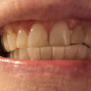 Jorge Garaicoa, DDS - LiveWell Dentistry - Before - Prosthodontists Near Me - Plantation, Florida Jorge Garaicoa, DDS - LiveWell Dentistry - Before - Prosthodontists Near Me - Plantation, Florida