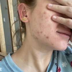 Stacy's Face & Skin Treatments - Before I started seeing Stacy
