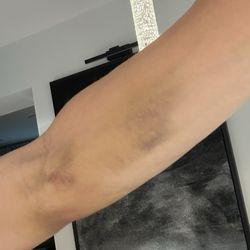 Quest Diagnostics - This should never happen from a simple blood draw