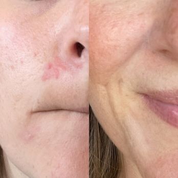 Wild Kind Beauty - virtual skin program - healing acne and perioral dermatitis - Waxing Near Me - Brooklyn, New York Wild Kind Beauty - virtual skin program - healing acne and perioral dermatitis - Waxing Near Me - Brooklyn, New York