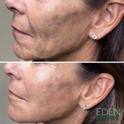 Eden Med - Sculptra B&A