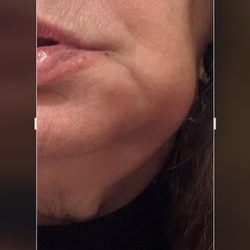 Jeffrey C Sklarin, DDS - Infection on the nerve from Dr. Sklarin