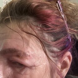 90th Nails - Severe reaction with blisters and scarring
