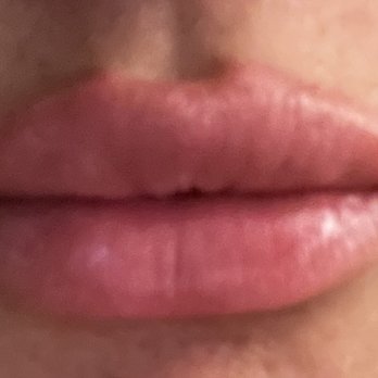Botoxie - Lip flip - Medical Spas Near Me - San Diego, California