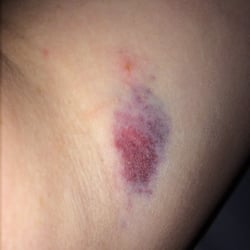 My arm the second day.