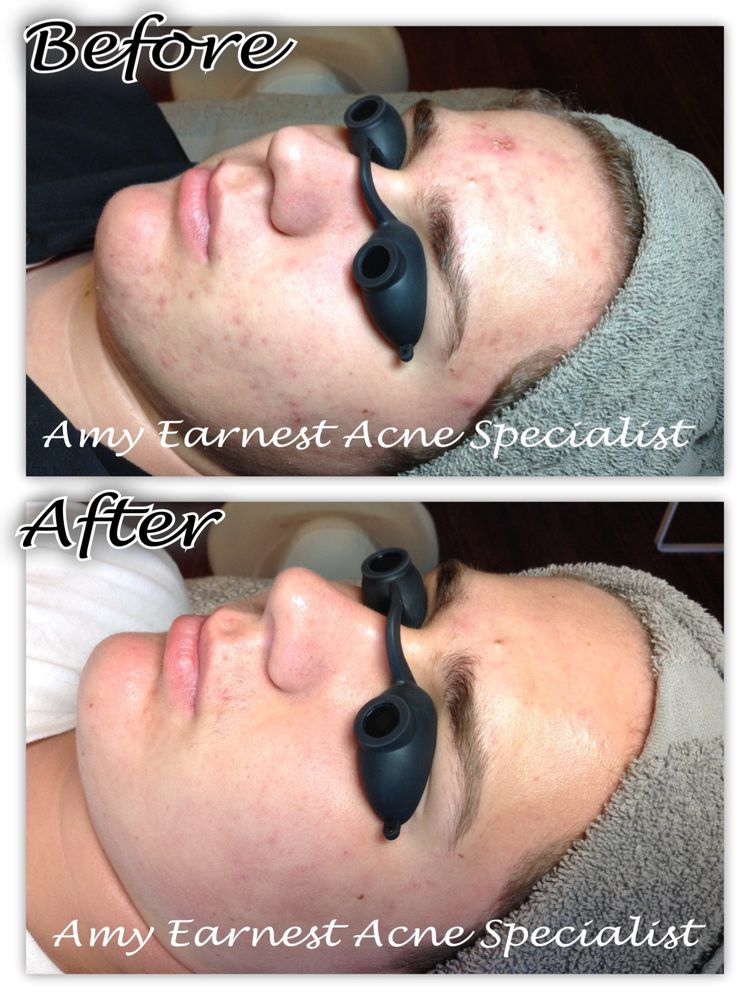Amy Earnest Acne Specialist Logo