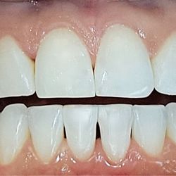 Metro Smiles, PC - After Invisalign + getting my front tooth fixed from having a chip