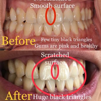 Hamilton Mountain Dental Group - Unprofessional! Unsafe! Money first! Violent and inhuman hygienist Lisa! - General Dentistry Near Me - Hamilton, Ontario Hamilton Mountain Dental Group - Unprofessional! Unsafe! Money first! Violent and inhuman hygienist Lisa! - General Dentistry Near Me - Hamilton, Ontario