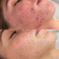 The Acne Concept - Before & After