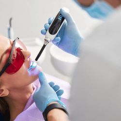 Dunwin Dental - Dental Sealants in Mississauga - a dentist applying dental sealants on the teeth of a female patient and curing them with a curing light