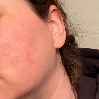 Jiva Med Spa - Columbus - Burn healed after last BBL. - Medical Spas Near Me - Columbus, Ohio