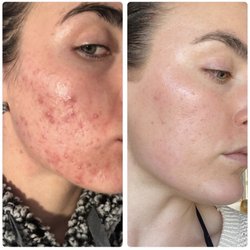 Tayshea Esthetics - Client skin transformation!