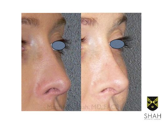 Shah Aesthetic Surgery - Rhinoplasty and Facelift Specialist by null