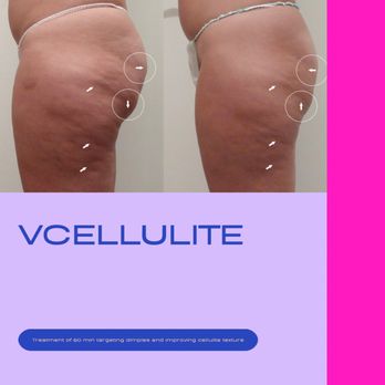 Top Body Contouring - Cellulite treatment week special! - Body Contouring Near Me - Birmingham, Alabama Top Body Contouring - Cellulite treatment week special! - Body Contouring Near Me - Birmingham, Alabama