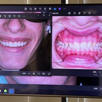 Harmetz & Kim Dentistry - Before on right... After on left! - General Dentistry Near Me - San Diego, California Harmetz & Kim Dentistry - Before on right... After on left! - General Dentistry Near Me - San Diego, California