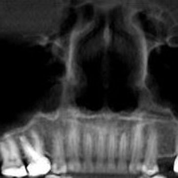 Greater Chattanooga Orthodontics - Tilted molar roots and a lowered sinus pocket - Orthodontists Near Me - Chattanooga, Tennessee Greater Chattanooga Orthodontics - Tilted molar roots and a lowered sinus pocket - Orthodontists Near Me - Chattanooga, Tennessee