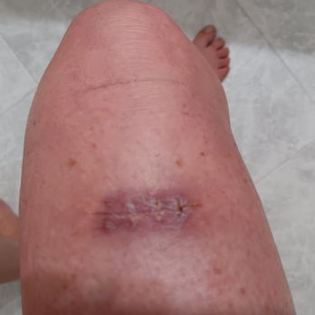 Forefront Dermatology Franklin, WI - Pseudomonas aeruginosa infection - Dermatologists Near Me - Franklin, Wisconsin Forefront Dermatology Franklin, WI - Pseudomonas aeruginosa infection - Dermatologists Near Me - Franklin, Wisconsin