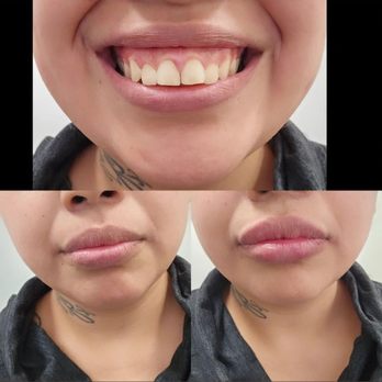 ME Medspa - My results - Medical Spas Near Me - Monterey Park, California ME Medspa - My results - Medical Spas Near Me - Monterey Park, California