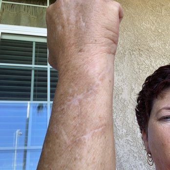 Eric L. Giang, D.O - The healed arm  ! Thanks doctor Giang - Orthopedists Near Me - Modesto, California