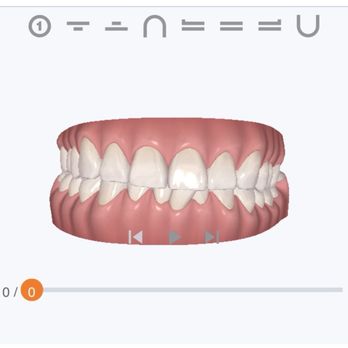 One Smile Orthodontics - Invisalign set 1 - Orthodontists Near Me - West Covina, California One Smile Orthodontics - Invisalign set 1 - Orthodontists Near Me - West Covina, California