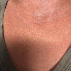 Emiko Therapeutic Massage - Her skin was so bad like this but it changed to