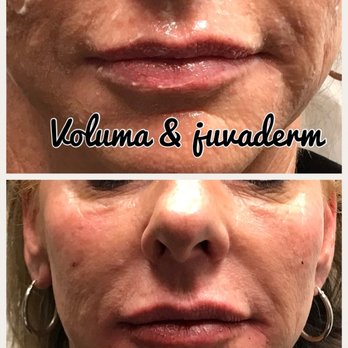 Aloha Nani Kino Spa - Voluma in the cheeks and Juvaderm in the lips - Medical Spas Near Me Aloha Nani Kino Spa - Voluma in the cheeks and Juvaderm in the lips - Medical Spas Near Me