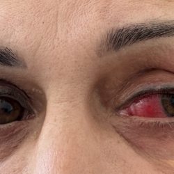 North Valley Eye Medical Group - Recommended her to take Ibuprofen for this. She had been doing that for 6 weeks. No other advice or help. No care at all.