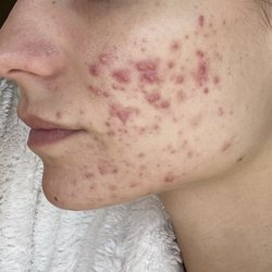 Jessica Jones Skin Care - Before photo