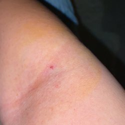 KEDPLASMA Burlington - The bruise in this is under the surface where they missed and missed again.