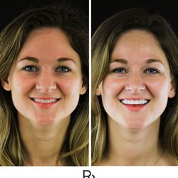 Restoration Dental - Smile makeover with conservative prep veneers!