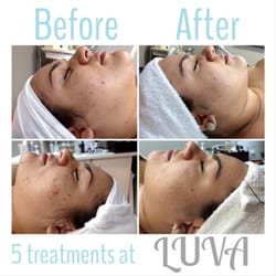 Luva Hair and Day Spa - PCA Peel at LUVA and 5 treatments later my skin has never looked & felt better. I still have some to go, but it was so worth it!