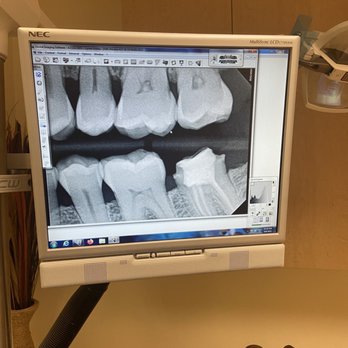 Summy Abbassi, DDS - Getting a new crown. - Cosmetic Dentists Near Me - Tarzana, California