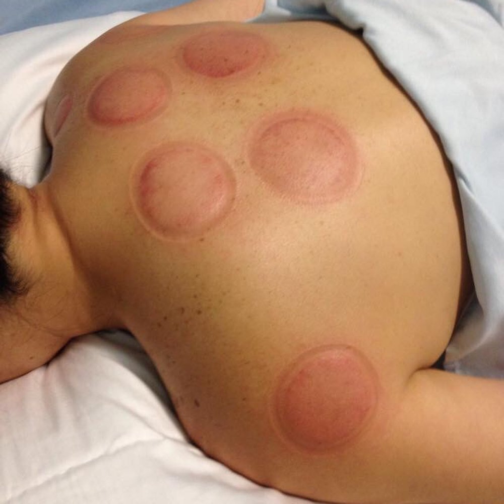 Revive Massage & Wellness - Cupping doesn't hurt at all and leaves you feeling so good after! - Massage Therapy Near Me - Līhue, Hawaii Revive Massage & Wellness - Cupping doesn't hurt at all and leaves you feeling so good after! - Massage Therapy Near Me - Līhue, Hawaii