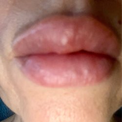 Mayberry Plastic Surgery - 14 Days After Bad Filler Technique