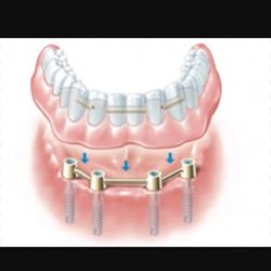 Sun City Dental - We offer these services with over 15 yrs experience