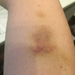 Bruises found after massage. Bruises found after massage.