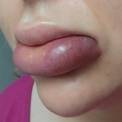 Urbane Beauty - Infected abscess from unsanitary lip fillers.
