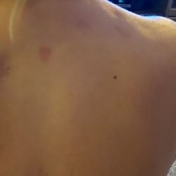Nevada Pain Care - TRIGGER INJECTIONS ADMINISTRATORED INCORRECTLY