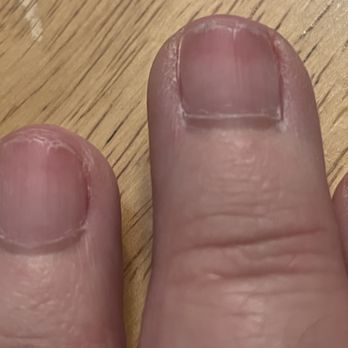 Malis Nails Boutique - Ruined Nail beds caused by wrong product used for polish removal and excessive drilling to remove polish. - Nail Salons Near Me - Lowell, Massachusetts