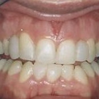 Star Sedation Dentristry - After Bonding - General Dentistry Near Me - Omaha, Nebraska Star Sedation Dentristry - After Bonding - General Dentistry Near Me - Omaha, Nebraska