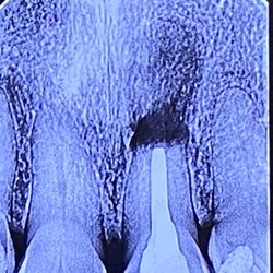 RootVision Endo - Post Apicoectomy On on the Same Day of the Operation (after antibiotics insertion two weeks prior to the operation)