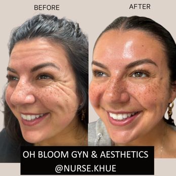 Oh Bloom Gyn - Tox before and after with Jeuveau. - Obstetricians & Gynecologists Near Me - Tustin, California Oh Bloom Gyn - Tox before and after with Jeuveau. - Obstetricians & Gynecologists Near Me - Tustin, California