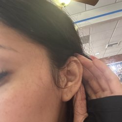 Wendy K Y Ng, MD - This is where my keloid was. Now it has healed and looks like my ear again