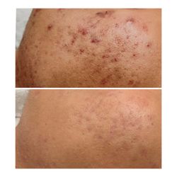 Your Skin By Sabrina - Acne leaves Hyperpigmentation. Before and after Five months apart.