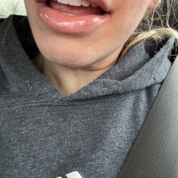 Lip filler by Mel