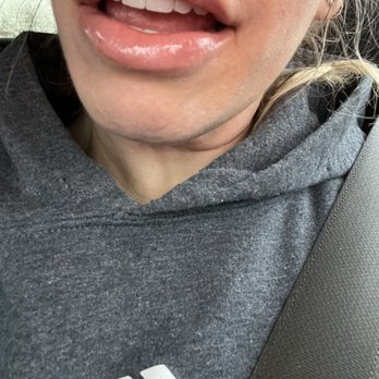 Ageless Image - Lip filler by Mel - Skin Care Near Me - Santa Rosa, California