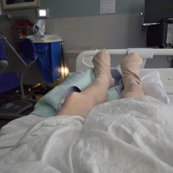 Summerville Medical Center - My feet after both big toes amputated.