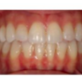 Bella Smile - After - Orthodontists Near Me - San Francisco, California Bella Smile - After - Orthodontists Near Me - San Francisco, California