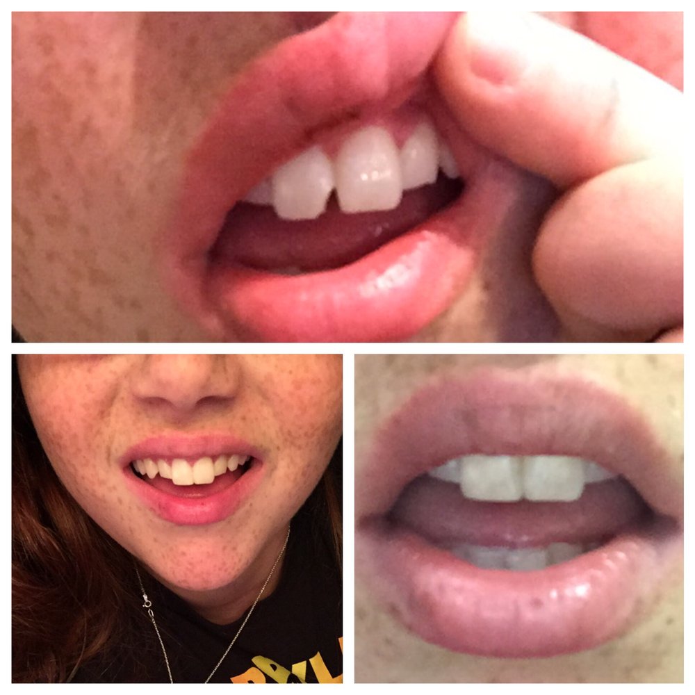 Brooklyn Heights Dental - Bonding done on 11/20 by Dr. Reid at BHD. Took less than 30 minutes and cost 400$ without insurance. - Cosmetic Dentists Near Me - Brooklyn, New York Brooklyn Heights Dental - Bonding done on 11/20 by Dr. Reid at BHD. Took less than 30 minutes and cost 400$ without insurance. - Cosmetic Dentists Near Me - Brooklyn, New York